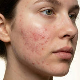 Imperfections/Peau acnéique