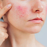 Rougeurs/Inflammations